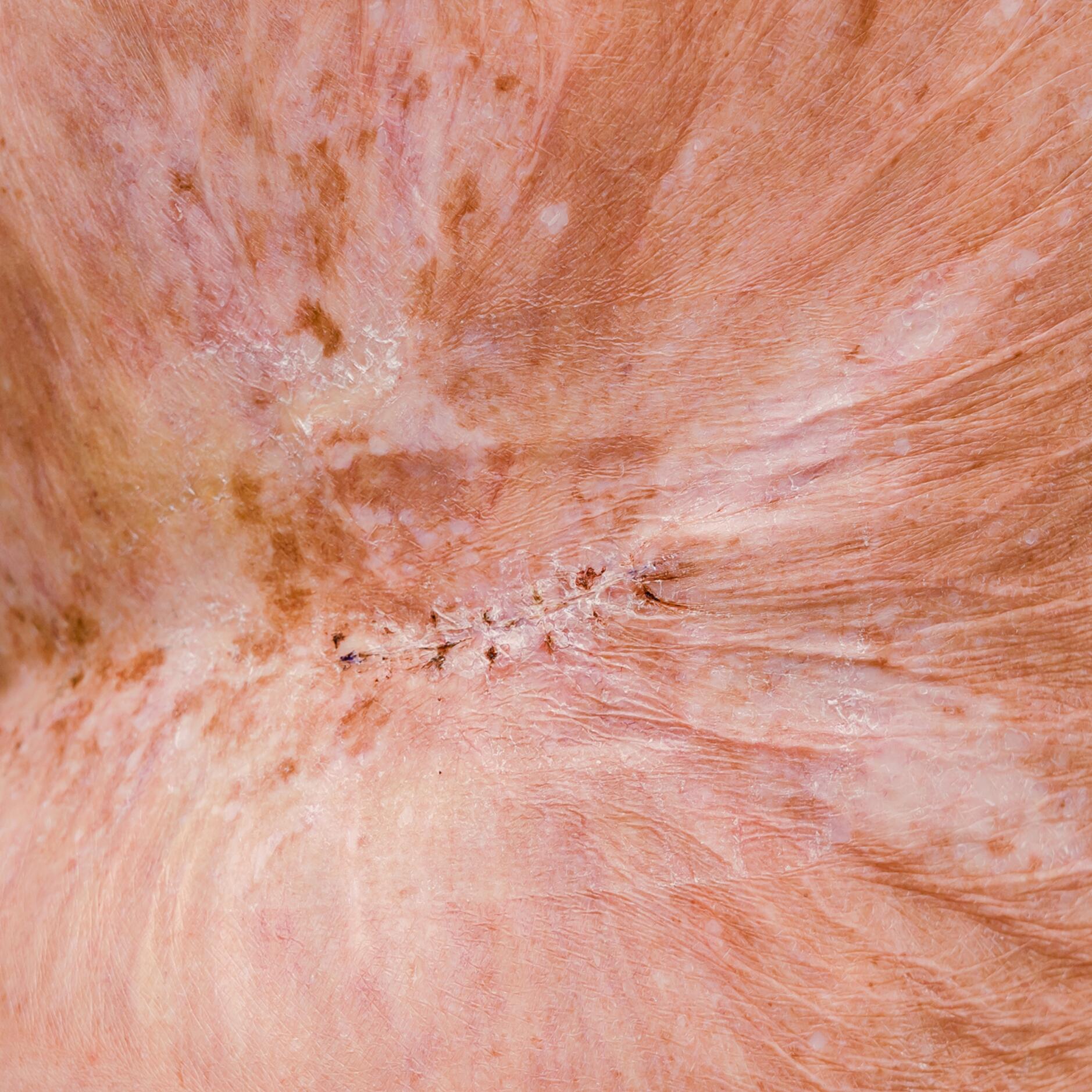 Quemadura de tercer grado